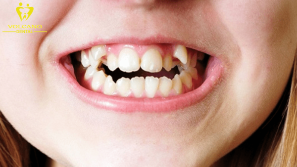 Răng nanh nhọn là chiếc răng đặc biệt nằm giữa nhóm răng hàm và răng cửa