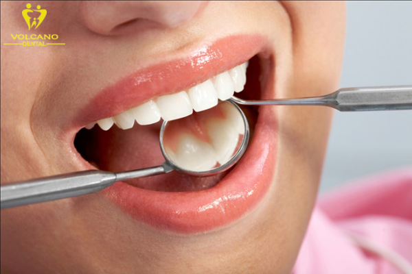 Khám răng định kỳ giúp phòng tránh tình trạng răng bị đen ở kẽ lan rộng