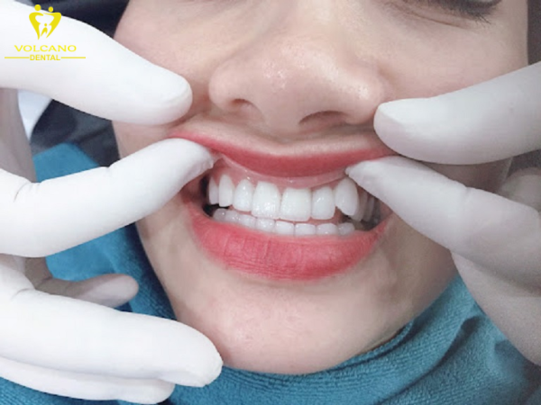 Răng nanh nhọn có thể khắc phục bằng cách bọc sứ