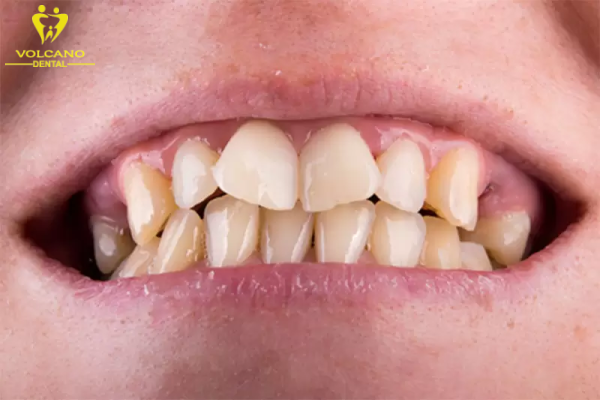 Răng quặp vào trong xảy ra khi các trục răng bị sai lệch vị trí hoặc khi khớp cắn không đúng