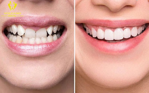 Phục hình răng sứ thẩm mỹ là một trong những phương pháp làm đẹp răng giúp chỉnh răng quặp