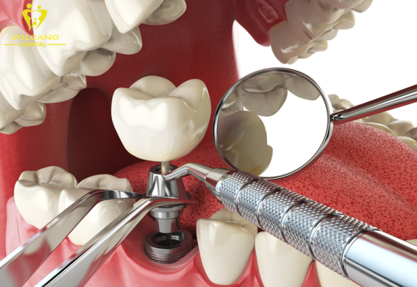 Nếu răng bị nứt hư hỏng nghiêm trọng, cần trồng Implant để khôi phục ăn nhai và thẩm mỹ