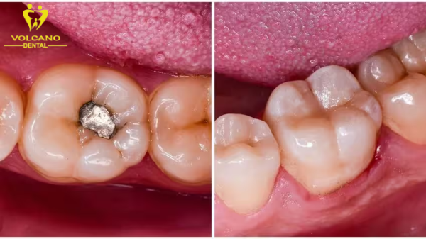 Tình trạng sâu răng vỡ nhỏ để khôi phục có thể trám răng