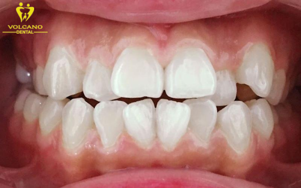 Răng 9630 là một kiểu răng không đẹp, gây ảnh hưởng đến thẩm mỹ và khả năng ăn nhai