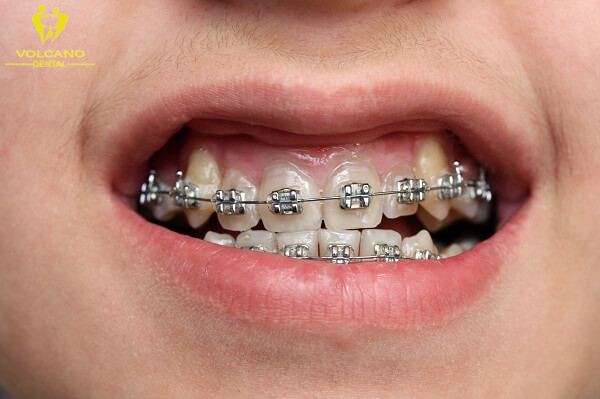 Niềng răng là một giải pháp hiệu quả để điều chỉnh vị trí của các răng khấp khểnh, từ nhẹ đến nặng