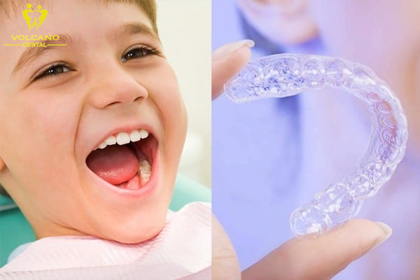 Niềng răng trong suốt Invisalign