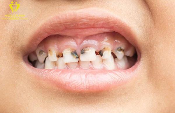 Men răng của trẻ bị tổn thương do răng sún