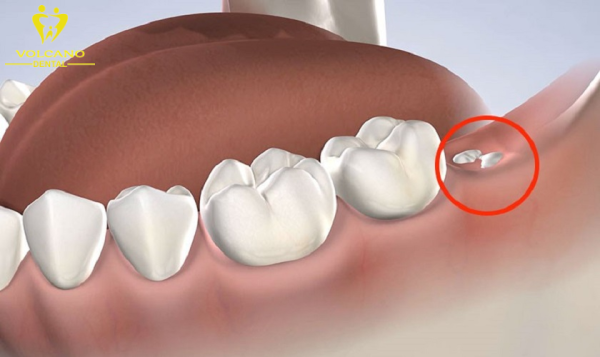 Răng khôn là bốn chiếc răng cuối cùng trong hàng răng sau cùng của hàm răng