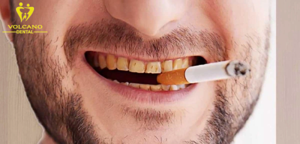 Thuốc lá có khả năng xâm nhập vào men răng làm thay đổi màu sắc gây vàng răng