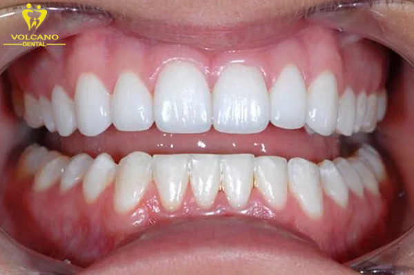 Bọc răng sứ là một phương pháp giúp trường hợp răng cửa không quá nghiêm trọng