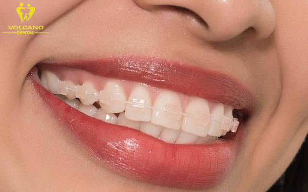 Niềng răng thẩm mỹ là phương pháp điều chỉnh răng miệng an toàn và tối ưu nhất để có được một hàm răng hoàn hảo và tự tin
