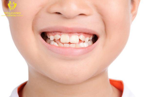 Trong quá trình mọc răng, việc chăm sóc răng miệng cho trẻ là rất quan trọng ngăn ngừa sâu răng