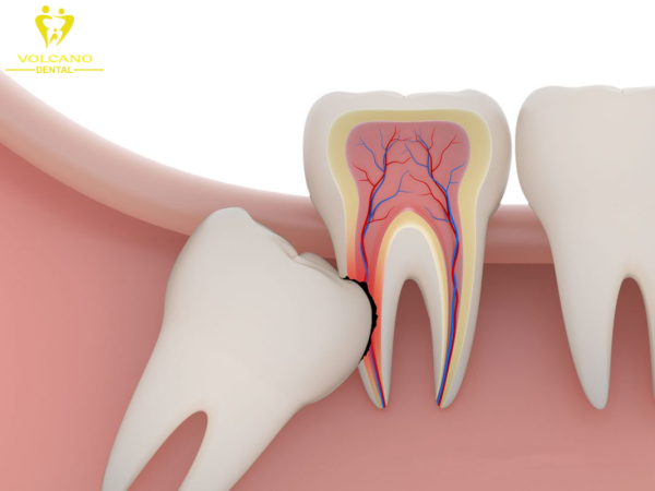 Việc không nhổ răng khôn có thể dẫn đến nguy cơ sâu răng, viêm nướu, u nang, áp xe