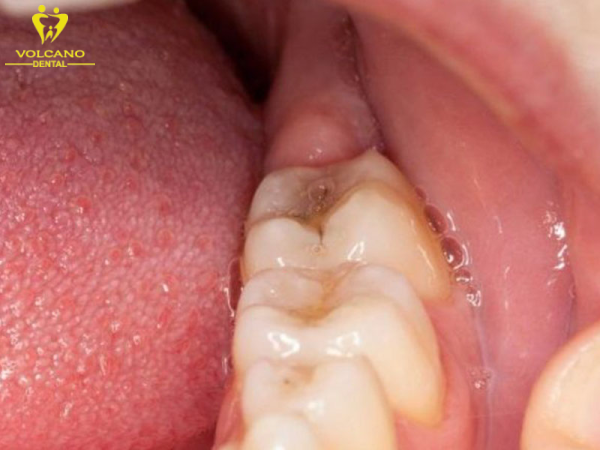 Răng khôn là răng hàm thứ ba, mọc ở phía sau miệng và là răng cuối cùng mọc lên