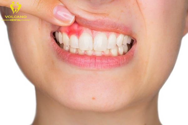 Viêm nha chu là một nguyên nhân phổ biến dẫn đến răng lung lay