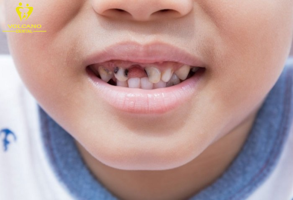 Sâu răng cũng có thể là một nguyên nhân gây ra hiện tượng răng lung lay
