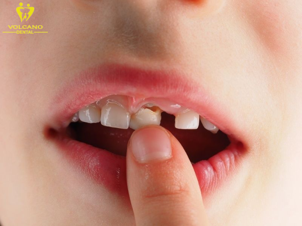 Răng lung lay là tình trạng mà các răng trong hàm không được giữ chặt và vững chắc như bình thường