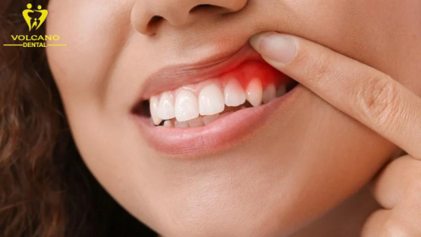 Cảm giác đau đớn ở vùng răng và nướu gần răng thừa là một dấu hiệu tình trạng răng mọc ngầm