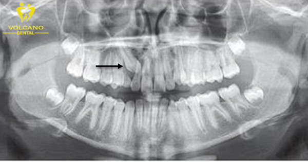 Phẫu thuật xử lý răng mọc ngầm là một phương pháp điều trị hiệu quả