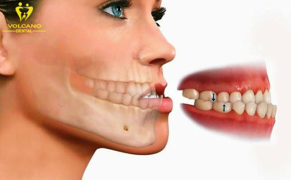 Răng móm ảnh hưởng đến thẩm mỹ và giảm tự tin trong giao tiếp