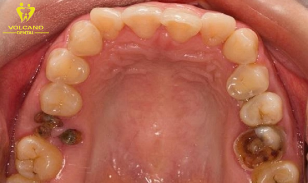 Răng số 7 bị sâu vỡ có thể gây ra nguy hiểm nếu không được xử lý kịp thời và đúng cách