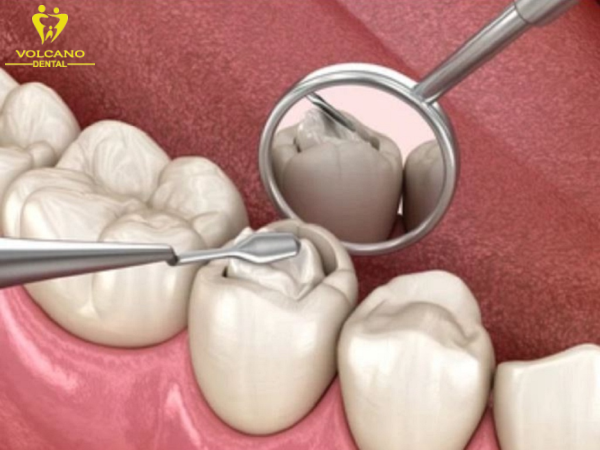 Trám răng là một phương pháp điều trị răng số 7 bị sâu vỡ