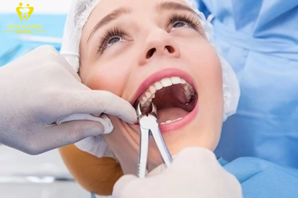 Nhổ răng là một trong những phương pháp điều trị răng số 7 bị sâu vỡ