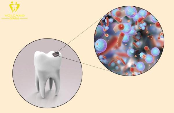 Tiêu diệt vi khuẩn gây sâu răng là lợi ích của chống xịt sâu răng