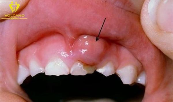 Ung thư nướu răng triệu chứng thường bao gồm sưng nướu, chảy máu nướu, đau nhức tại khu vực răng và nướu, mùi hôi miệng