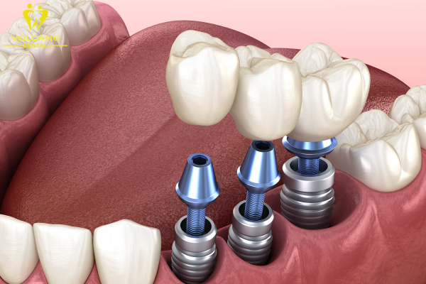 Cấy ghép Implant có chi phí cao cũng là 1 nhược điểm của trồng răng implant nhưng bảo tồn răng tốt hơn và có tuổi thọ lâu dài