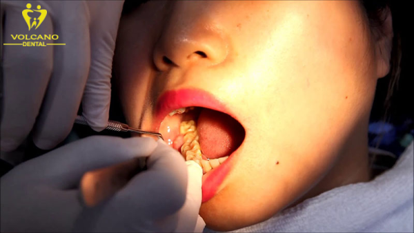 Sau khi điều trị viêm lợi trùm răng khôn cần chăm sóc miệng một cách đúng cách để tránh tái phát viêm