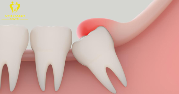 Lợi trùm răng khôn là tình trạng viêm nhiễm xảy ra khi răng khôn không có đủ không gian để mọc hoặc mọc không đúng hướng