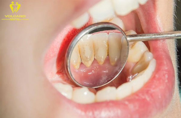Vôi răng không thể tự tróc ra, tuy nhiên có thể áp dụng một số cách để loại bỏ vôi răng tại nhà