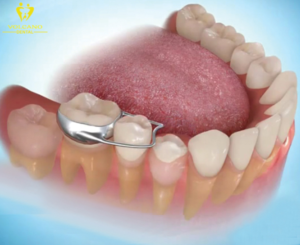 Nếu trẻ mất răng có thể sử dụng hàm giữa để duy trì khoảng trống của răng