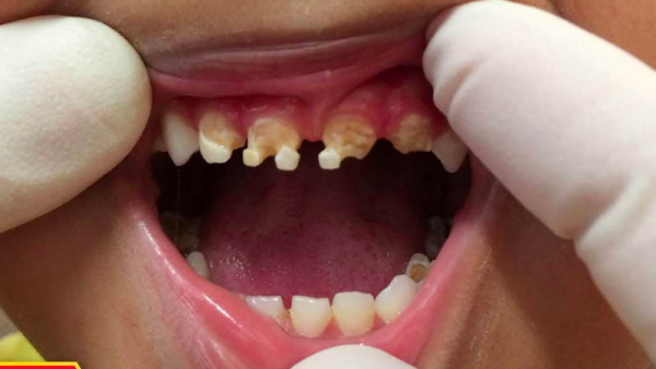 Có rất nhiều nguyên nhân gây ra tình trạng răng sữa bị mòn