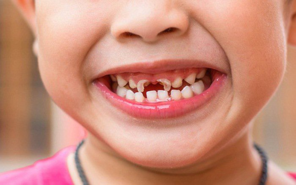Vấn đề mà nhiều phụ huynh phải đối mặt đó chính là tình trạng răng sữa của trẻ bị mòn