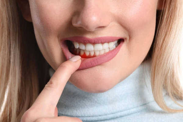 Tiêu xương hàm là một vấn đề răng miệng thường gặp hiện nay