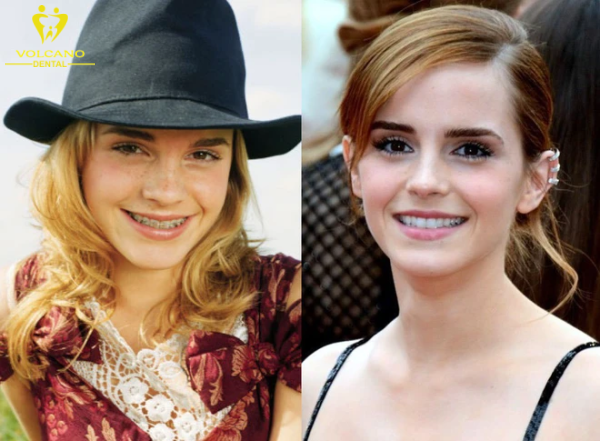 Emma Watson đã lựa chọn thực hiện niềng răng và sở hữu nụ cười đều đặn, rạng rỡ