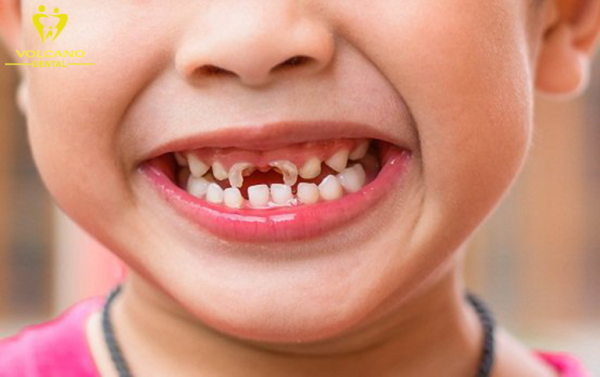 Có rất nhiều nguyên nhân dẫn đến tình trạng trẻ 7 tuổi bị sâu răng hàm