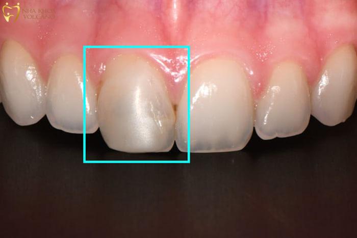 Những đường trầy xước