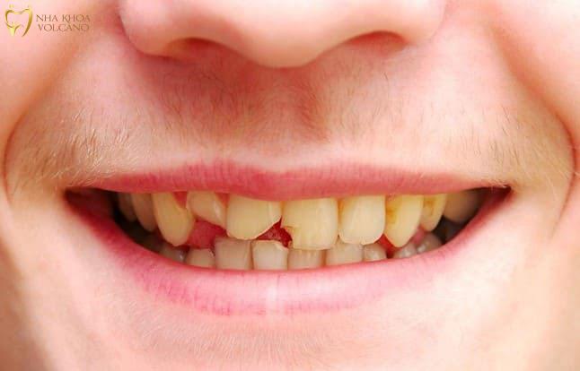 Triệu chứng của răng bị nứt
