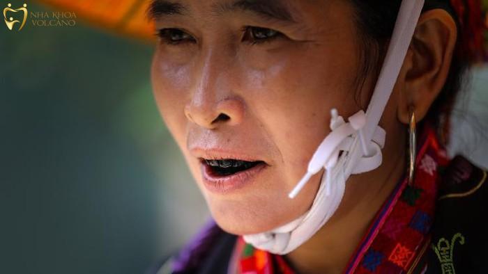 Những điều cần lưu ý khi nhuộm răng đen
