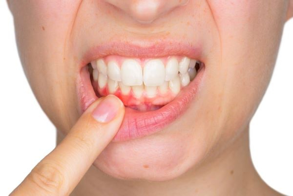 Khe nướu là một cấu tạo quan trọng của nướu răng