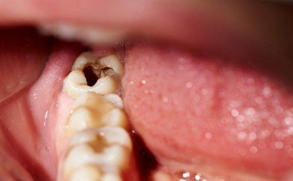 Do các bệnh lý khác về răng miệng