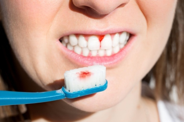 Phải làm sao để có thể hạn chế tình trạng chảy máu nướu răng?