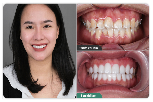 Hình ảnh răng sau khi mài và trước khi mài
