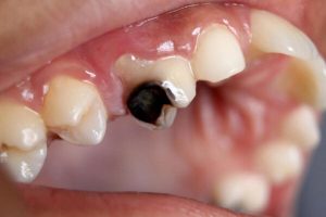 Tủy răng bị thối: Nguyên nhân và cách khắc phục hiệu quả