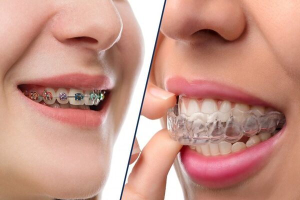 Niềng răng vô hình khác gì so với niềng răng thông thường
