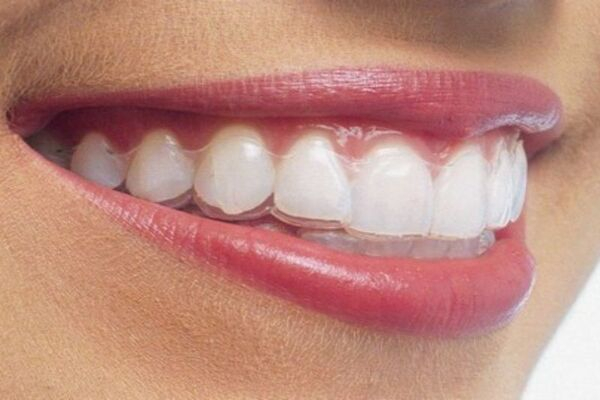 Cần lưu ý gì khi sử dụng niềng răng vô hình?