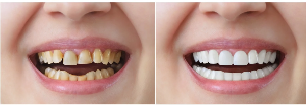 Bọc răng sứ dành cho đối tượng nào?